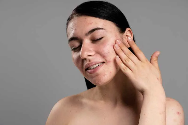 Why Dermatologists Keep Reaching for Azelaic Acid in Complex Skin Cases