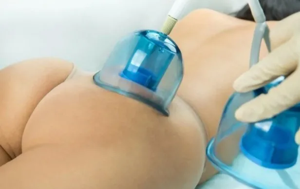 What a Vacuum Butt Lift Actually Does to Your Body (And What It Doesn't)