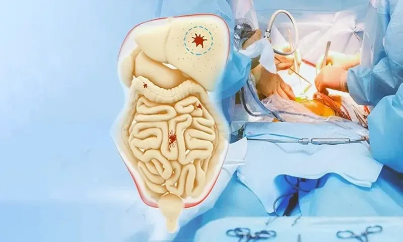 HIPEC Surgery in Delhi: A Breakthrough Treatment for Advanced GI Cancers