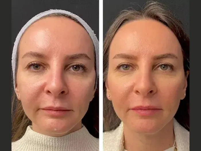 How the Best Plastic Surgeon in Dubai Delivers Safe and Effective Mesotherapy Results