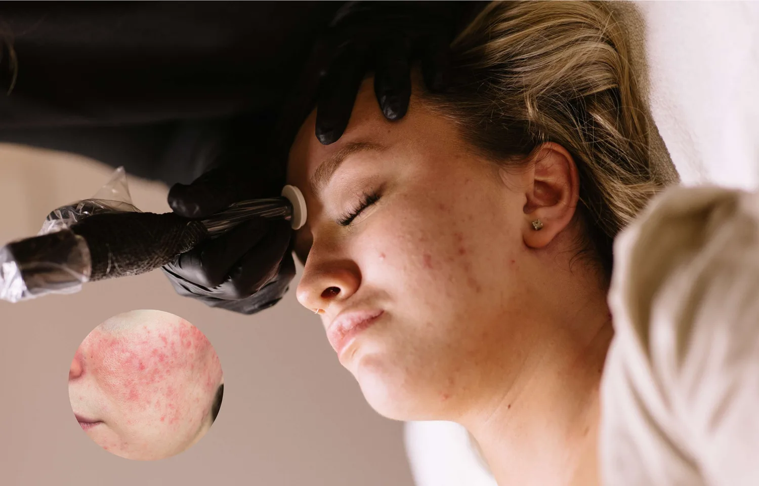 Top 7 Skin Concerns Procell Microchanneling Can Help Improve