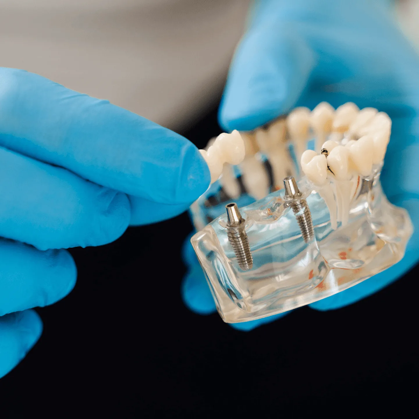 Everything Adults Over 50 in Temecula Need to Know About Dental Implants