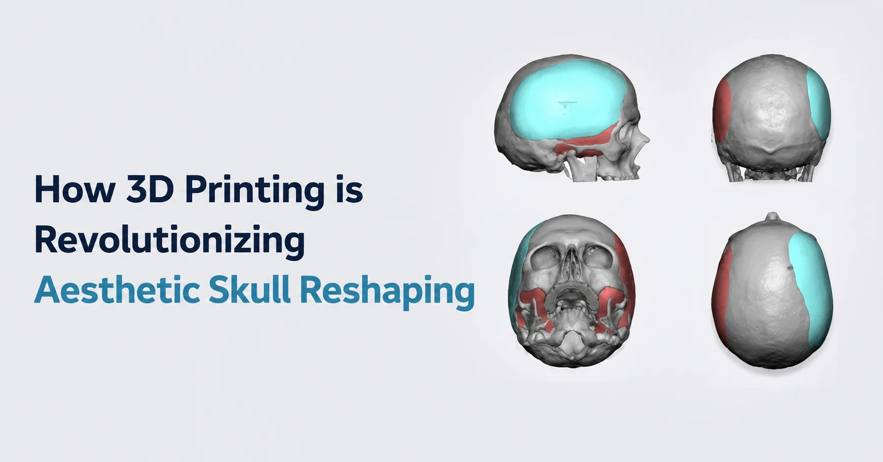 How 3D Printing is Revolutionizing Aesthetic Skull Reshaping