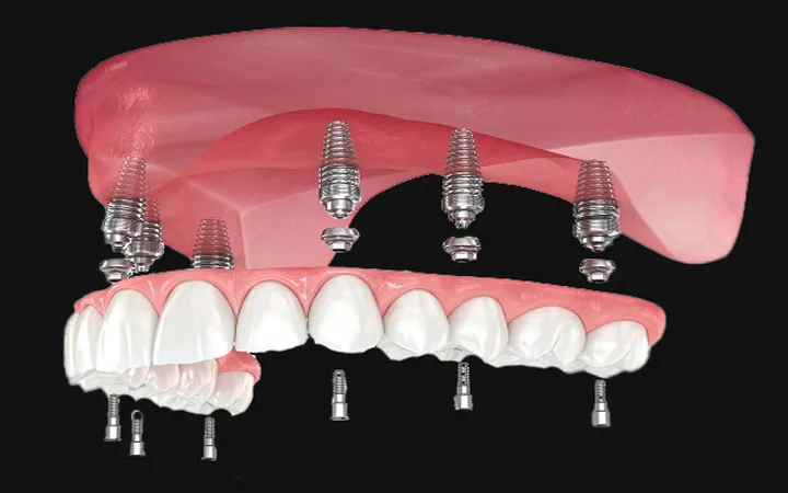 Restoring Structural Integrity: The Advanced Science and Lifelong Value of Modern Dental Implants