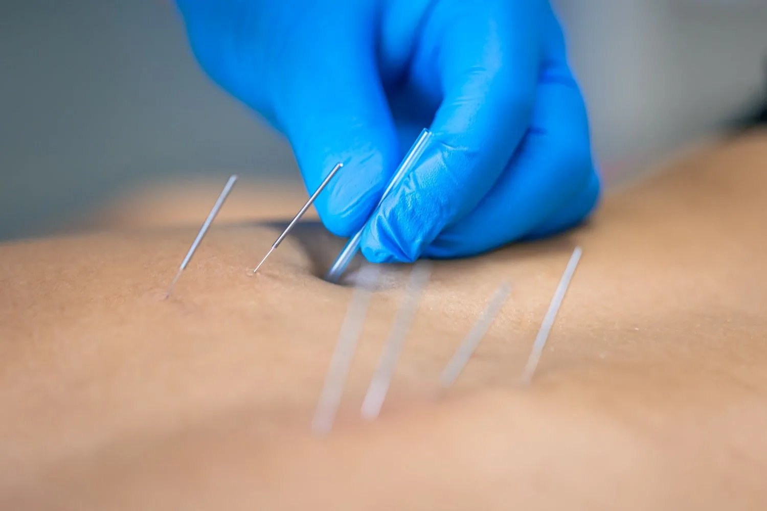 Are Chinese Acupuncture & Herbs Safe?