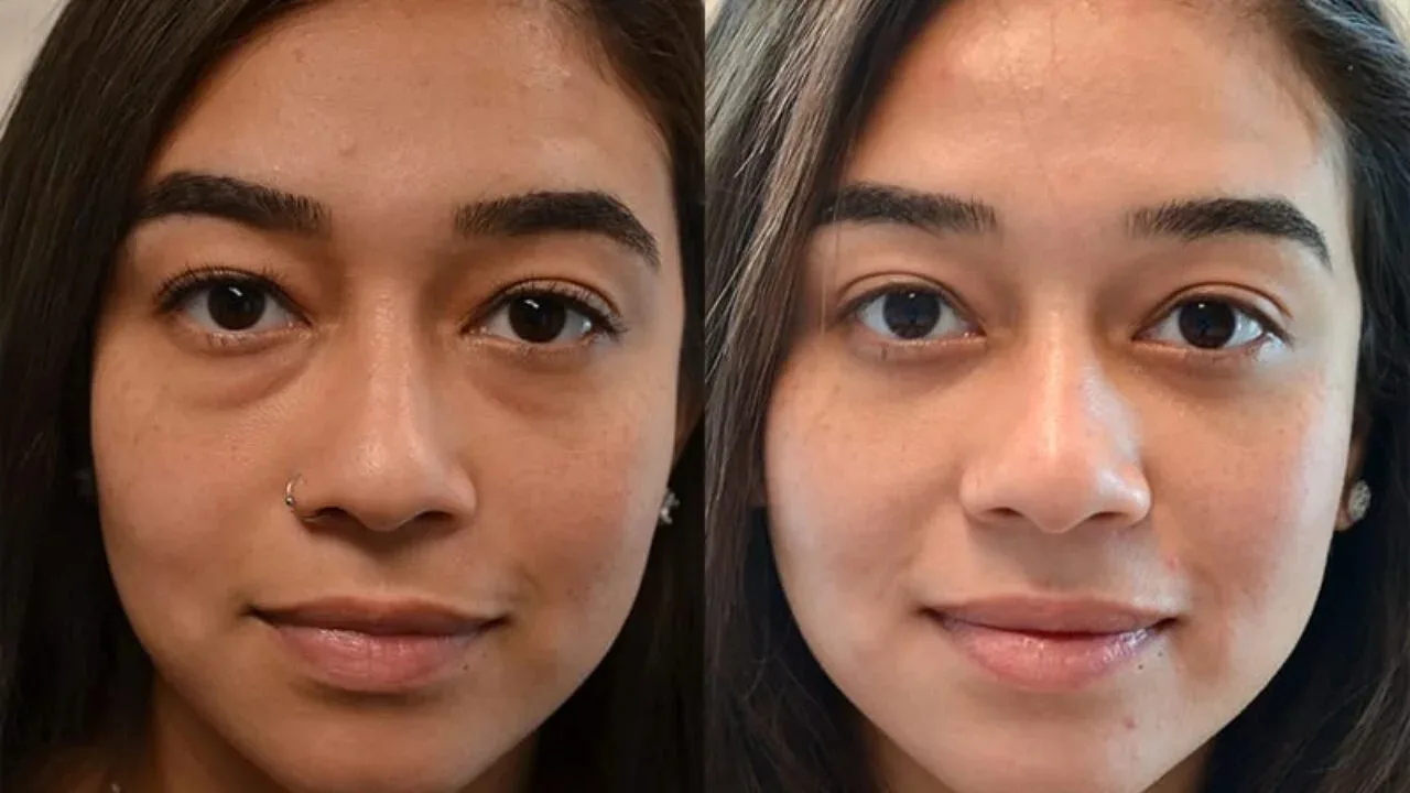 Blepharoplasty Surgery Cape Town: Upper & Lower Eyelid Surgery Guide