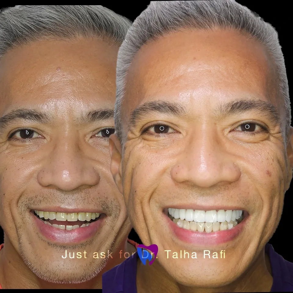 Is Teeth Whitening Safe? What You Should Know Before Brightening Your Smile
