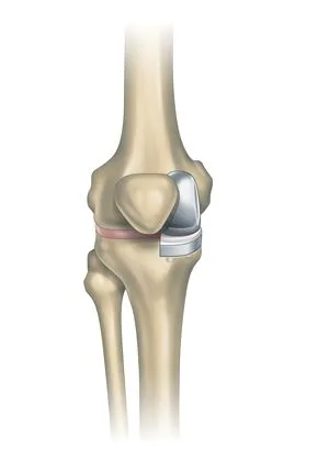 Partial Knee Replacement Surgery in Ghaziabad: Cost, Process, and Expert Care