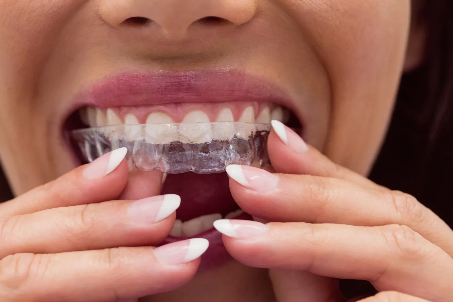 Invisalign Treatment in RR Nagar: Straighten Your Smile Discreetly