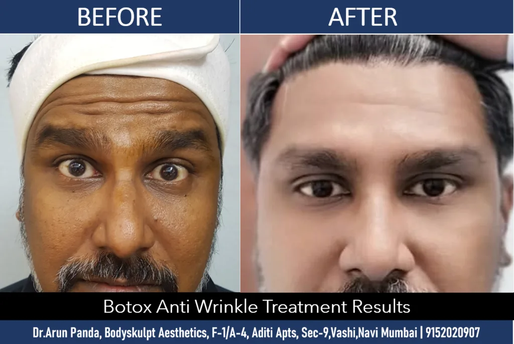 Thinking About Botox? Here's Everything You Need to Know Before Getting Botox Treatment in Navi Mumbai