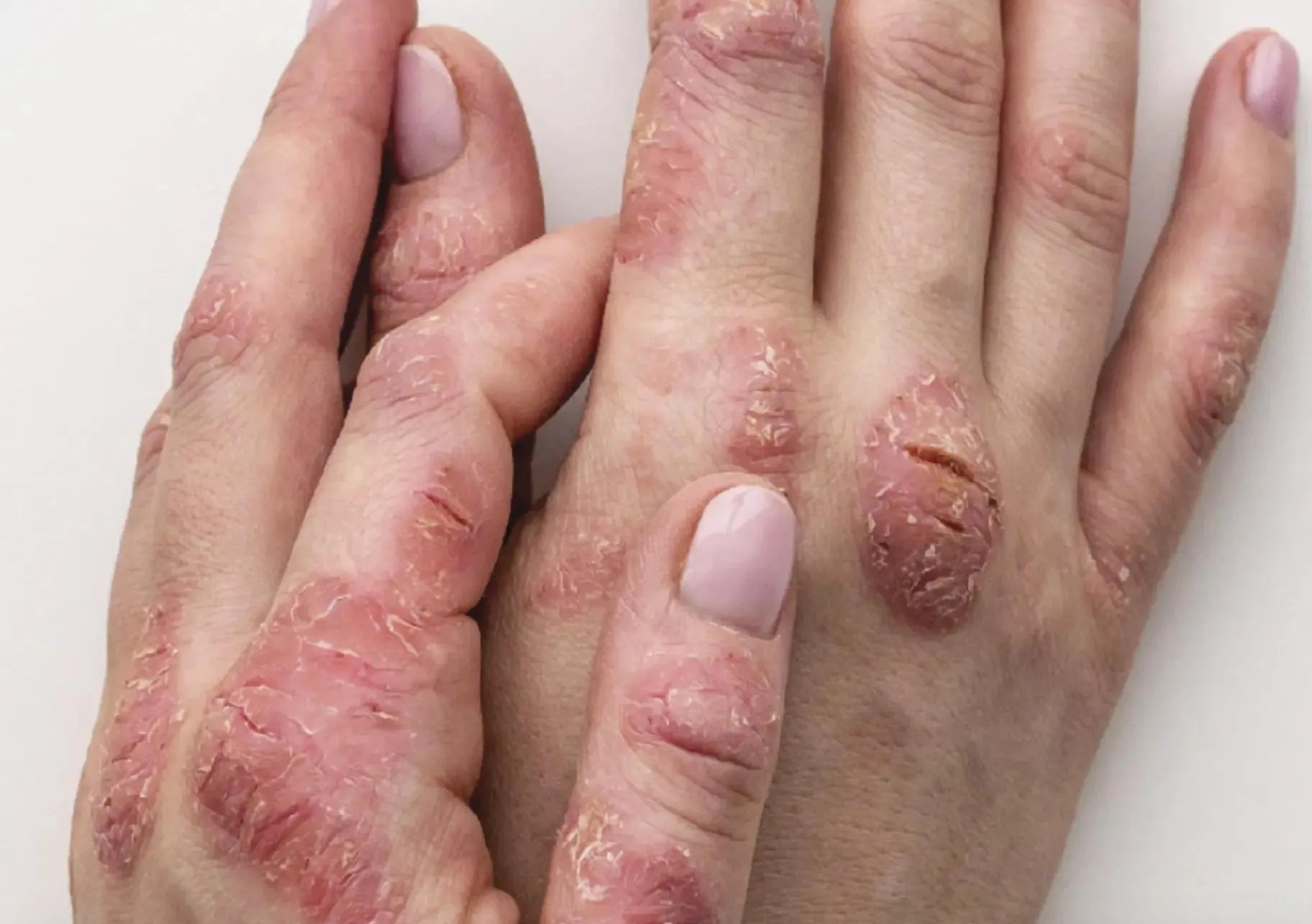 How to Choose the Right Eczema Treatment for Your Skin