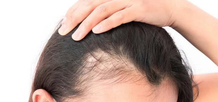 Hair Fall: Causes, Treatment Options and Prevention Tips
