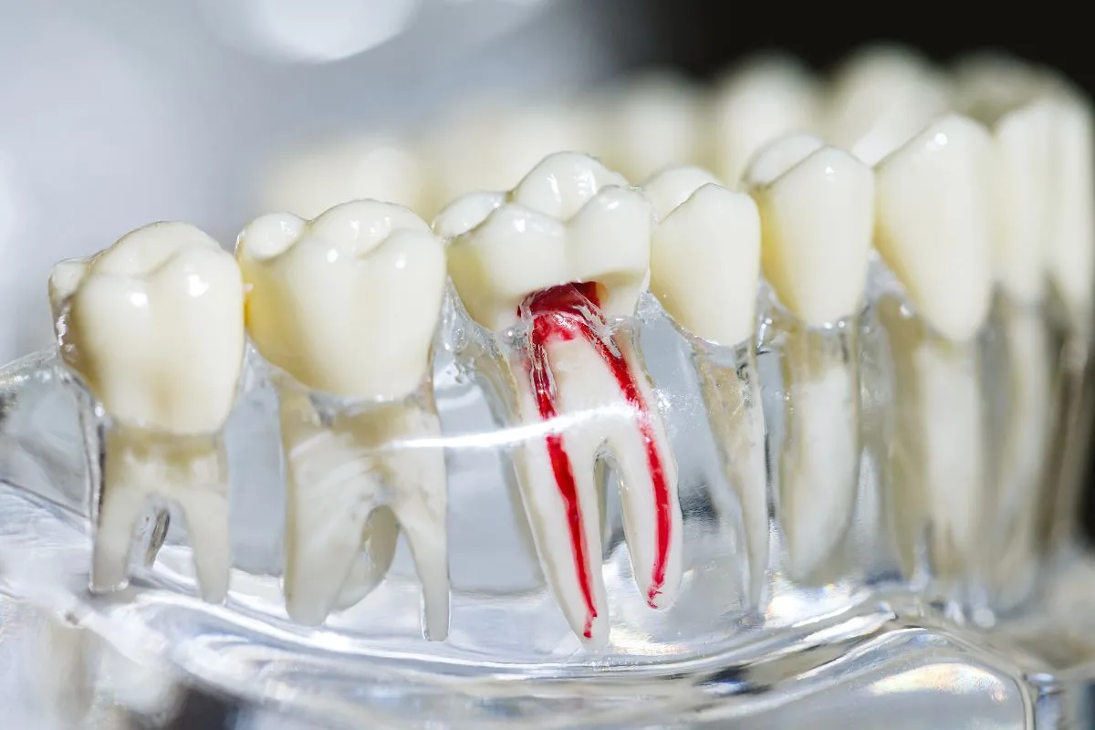 Save Your Natural Tooth with Root Canal in Brookefield Bengaluru – A Modern Solution for Lasting Oral Health
