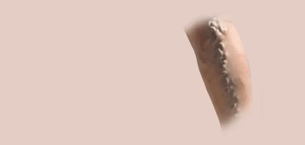 The Hidden Daily Habits Worsening Varicose Veins