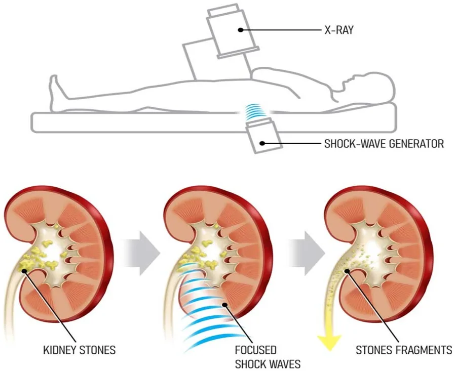 When a Middle-Class Family Searches for Shock Wave Lithotripsy in Bangalore