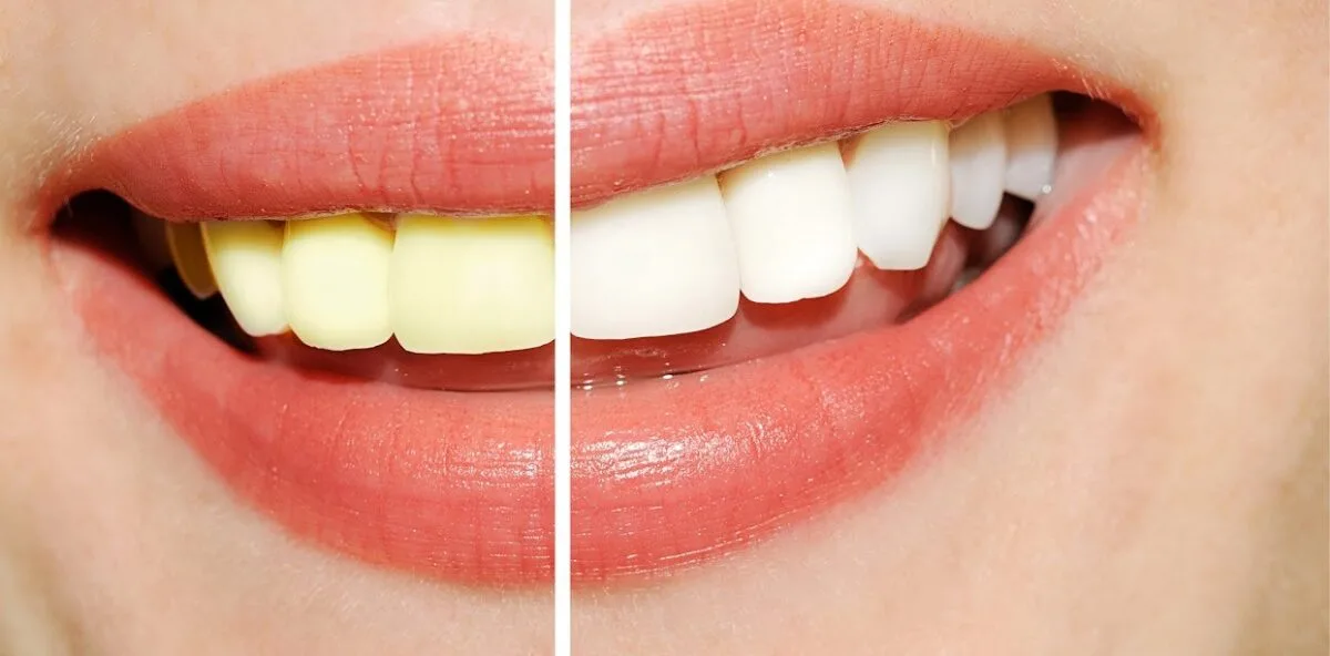 What Happens If You Skip Periodontal Maintenance in East Brunswick and Is It Really That Serious