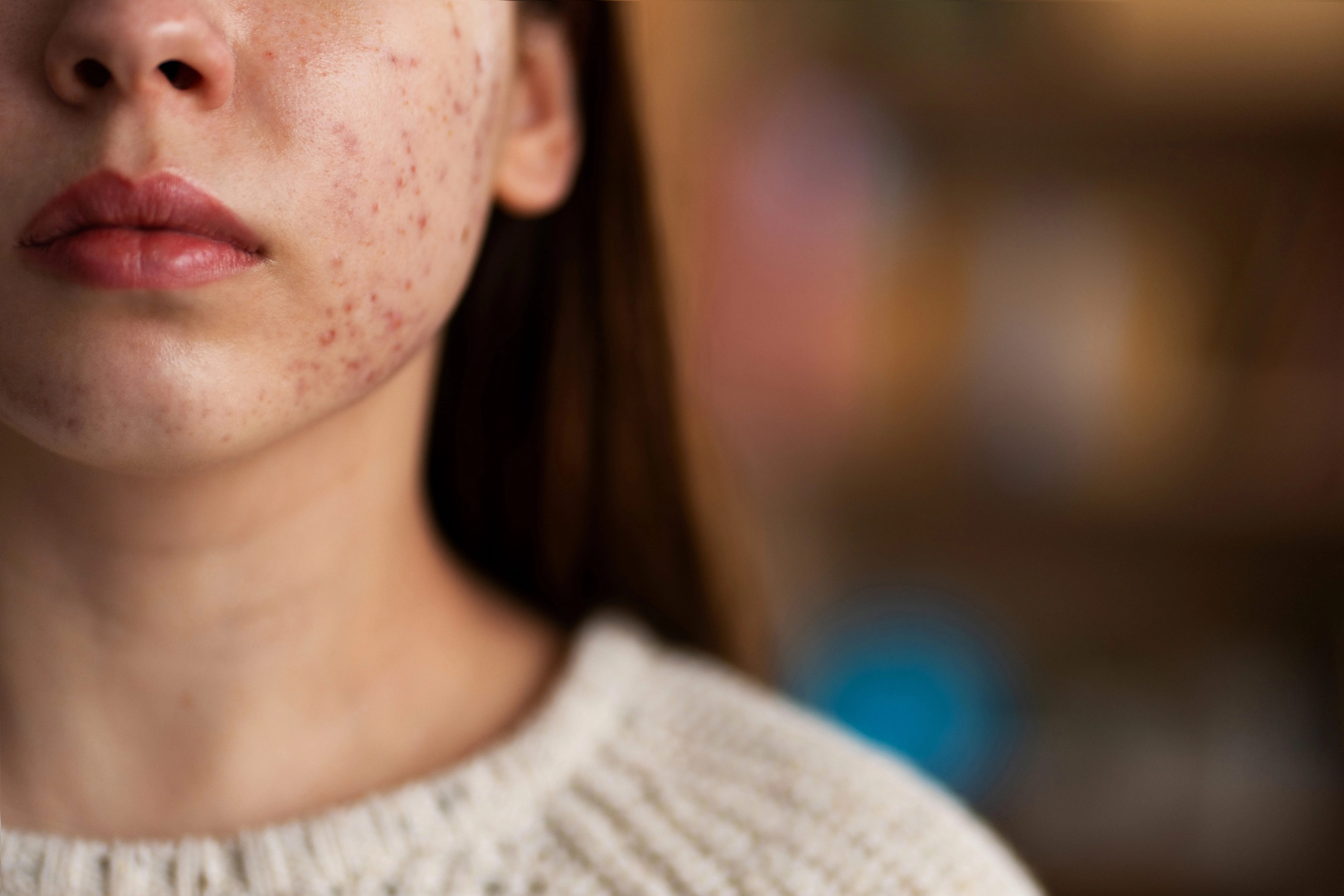 Types of Acne Scars and Their Treatment Options in Jayanagar