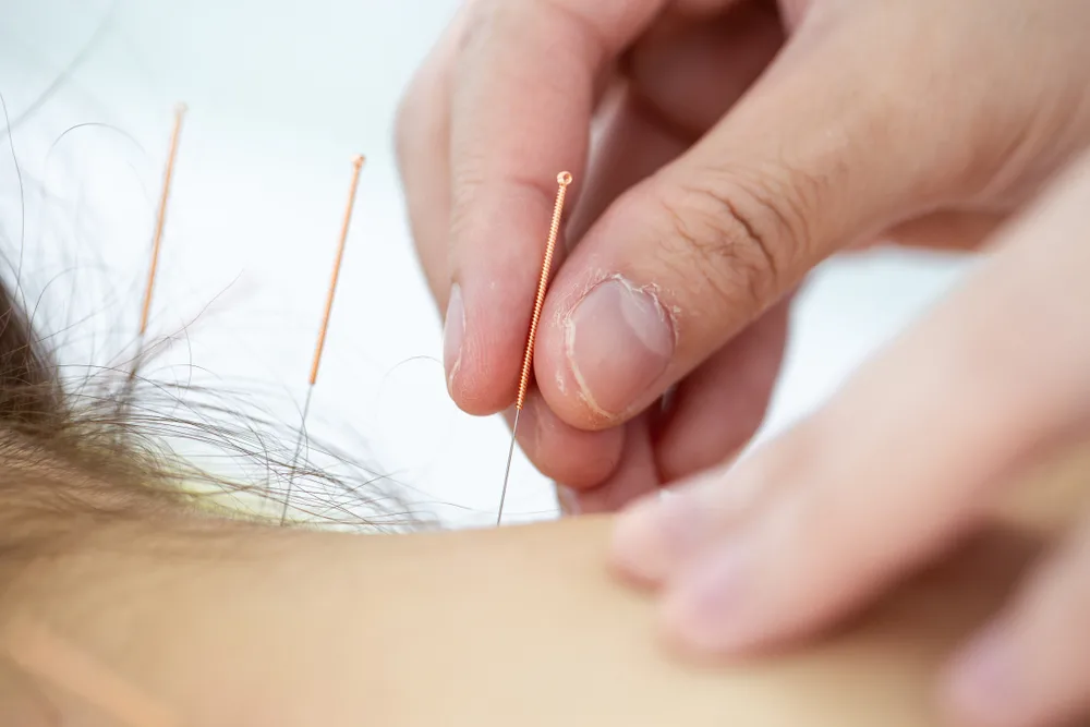 What Drives the Popularity of Acupuncture for Neck Pain in Edmonton