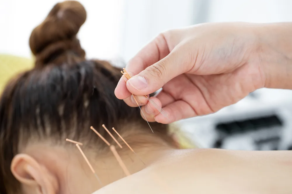 How Acupuncture for Neck Pain in Edmonton Can Relieve Chronic Discomfort