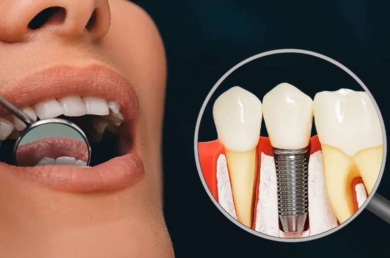 Dental Implants and Dentures: Choosing the Right Solution for a Healthy, Confident Smile