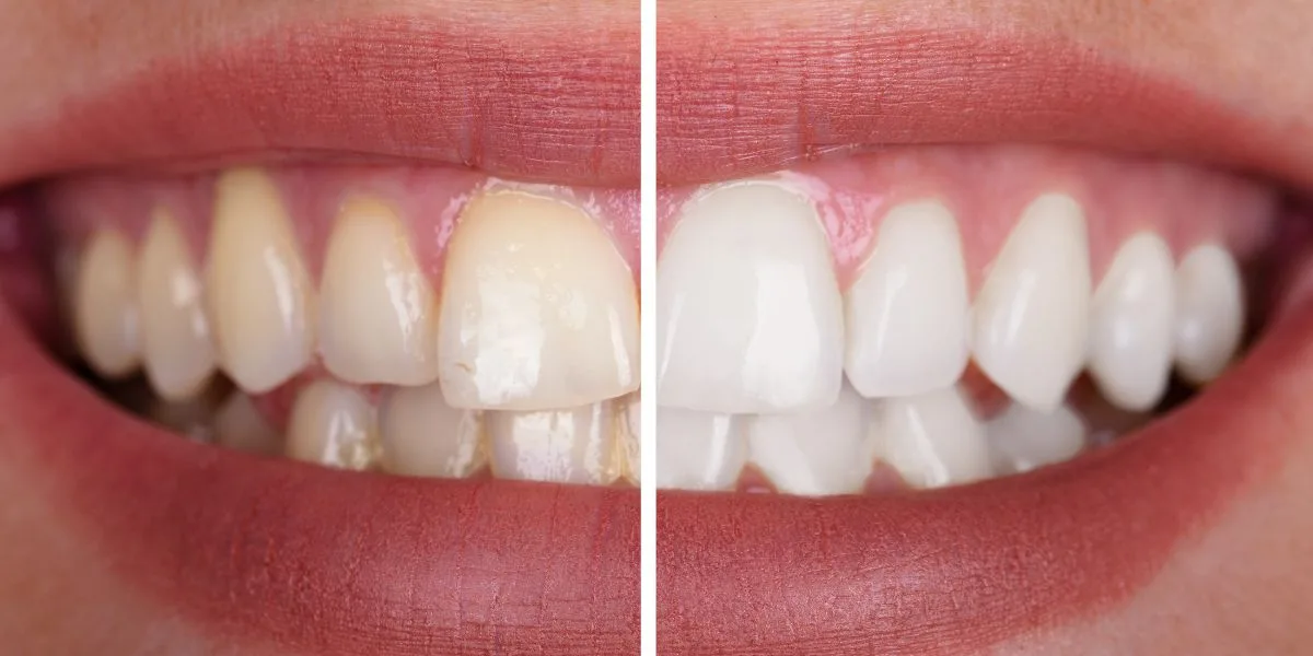 Teeth Whitening in Lahore: Professional Whitening, Methods, and Dental Care