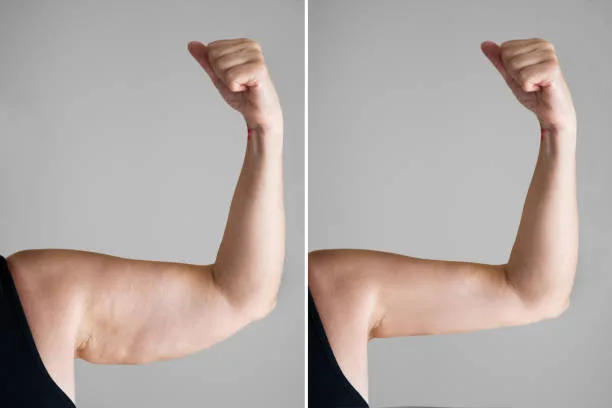 Exploring arm fat removal and Body Proportions