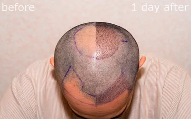 How the Best FUE Hair Transplant Clinic in Turkey Achieves Natural Hairlines