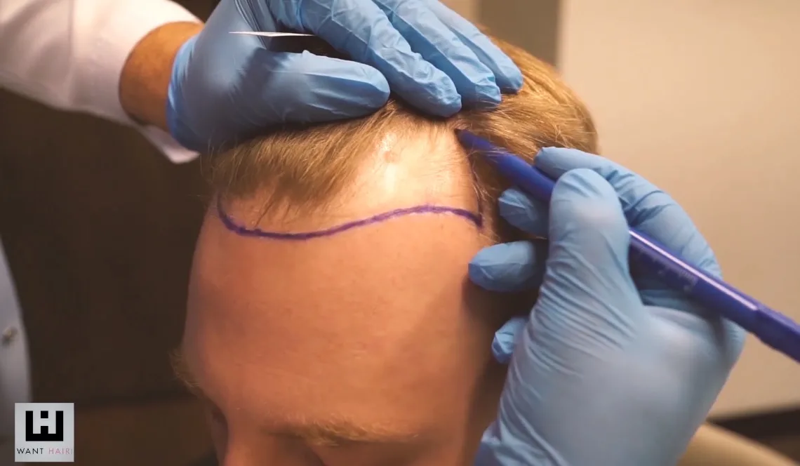 Affordable Hair Transplant Centres in Turkey That Don't Compromise on Quality