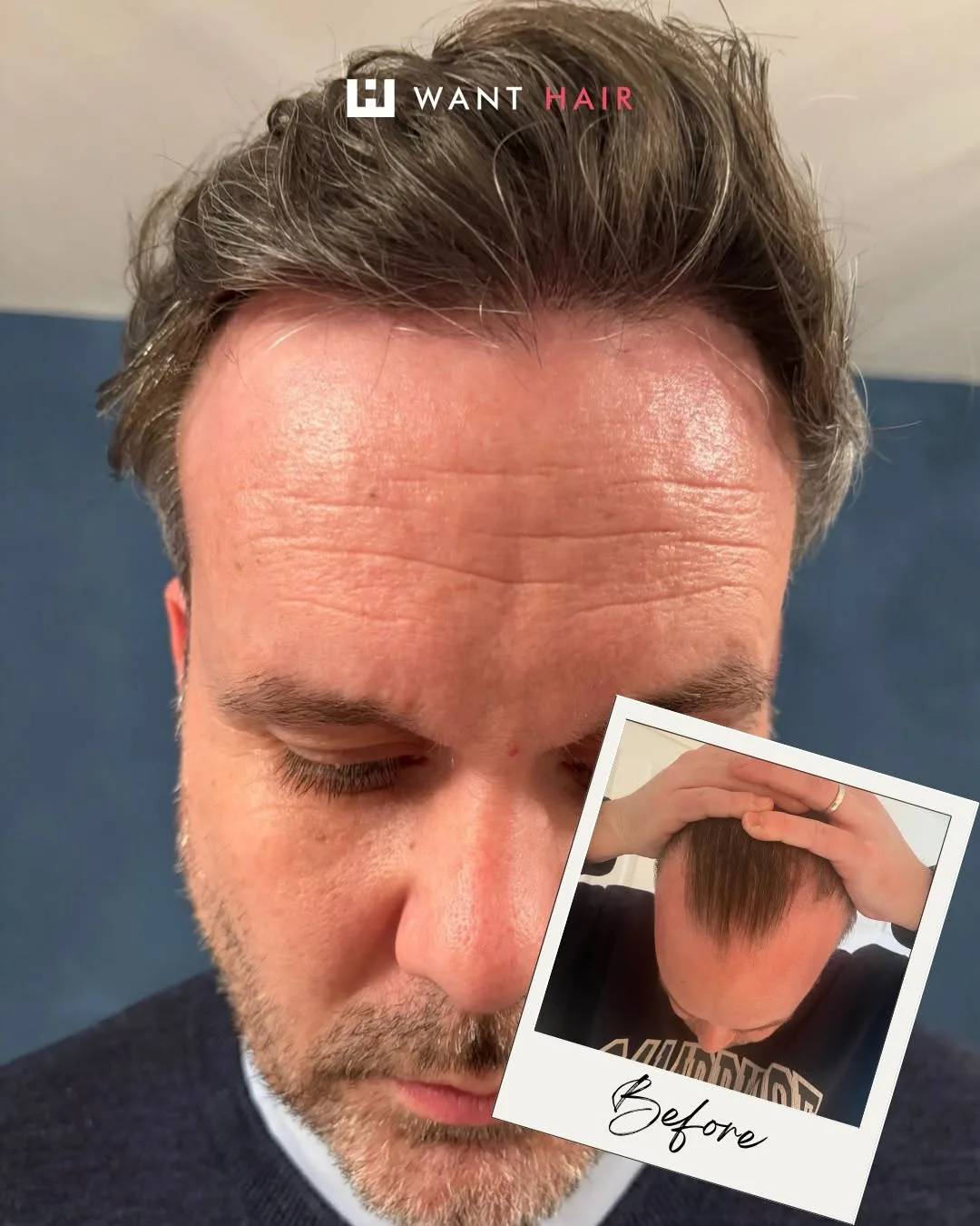 Best Hair Transplant in the UK - Natural Results, Trusted Specialists