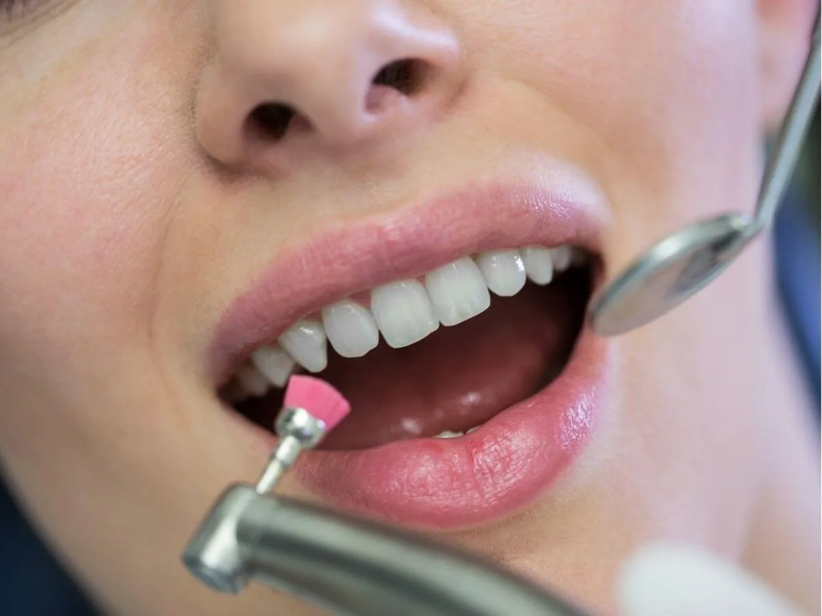 Best Teeth Whitening in Abu Dhabi – Achieve a Brighter, More Confident Smile with Marigold