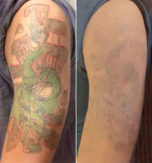 Tattoo Removal Before and After What to Expect From the Complete Process