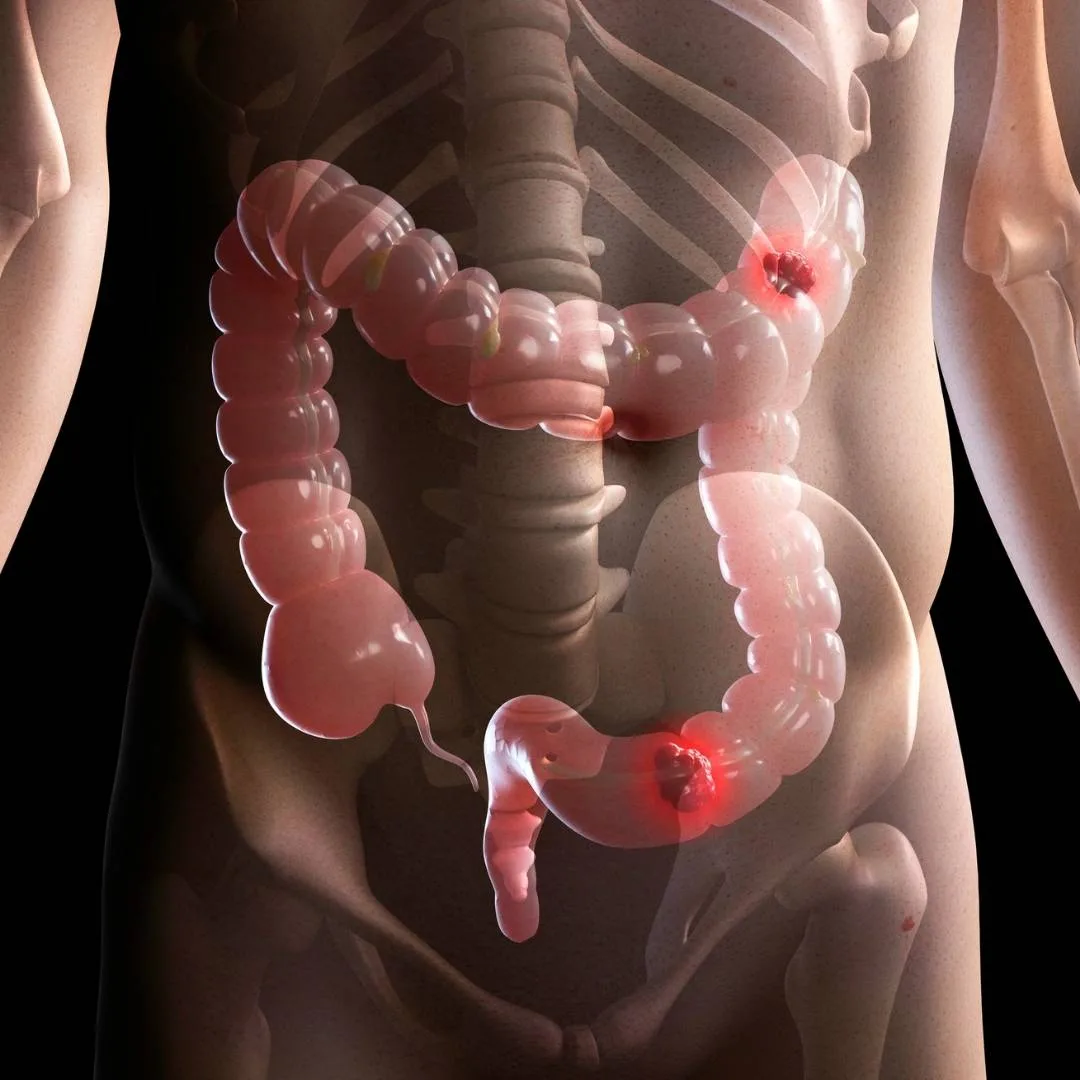 The Role of Robotic Surgery in Treating Colon Cancer: Benefits & Recovery