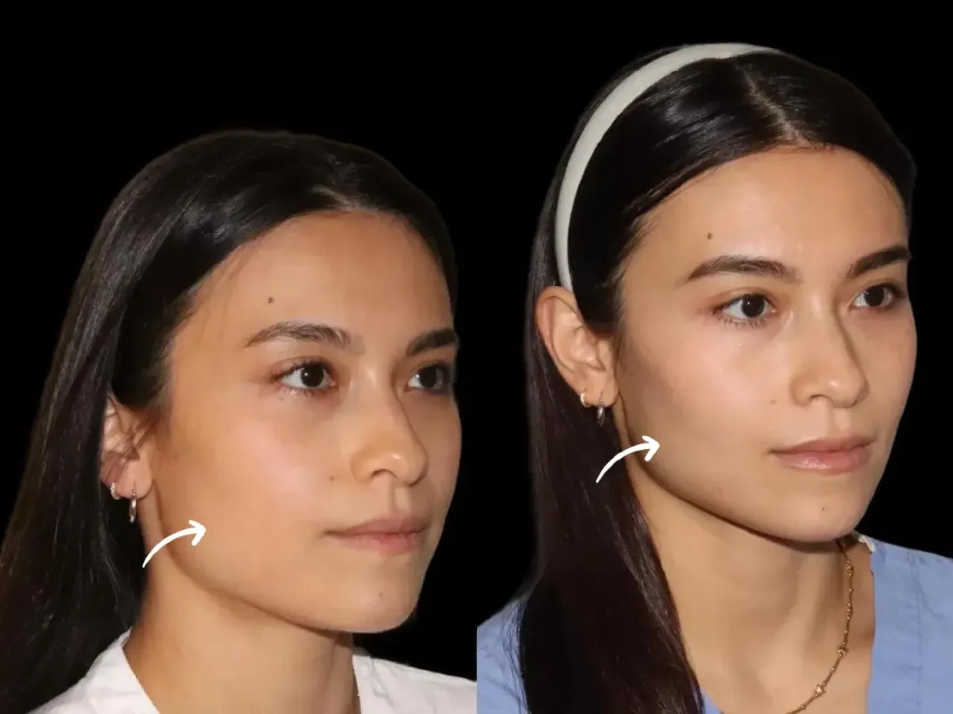The Rising Popularity of Sculptra Fillers in Dubai's Aesthetic Clinics