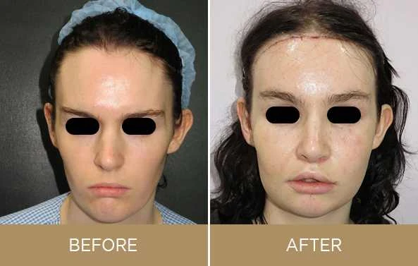 Top Frequently Asked Questions on Facial Feminization Surgery