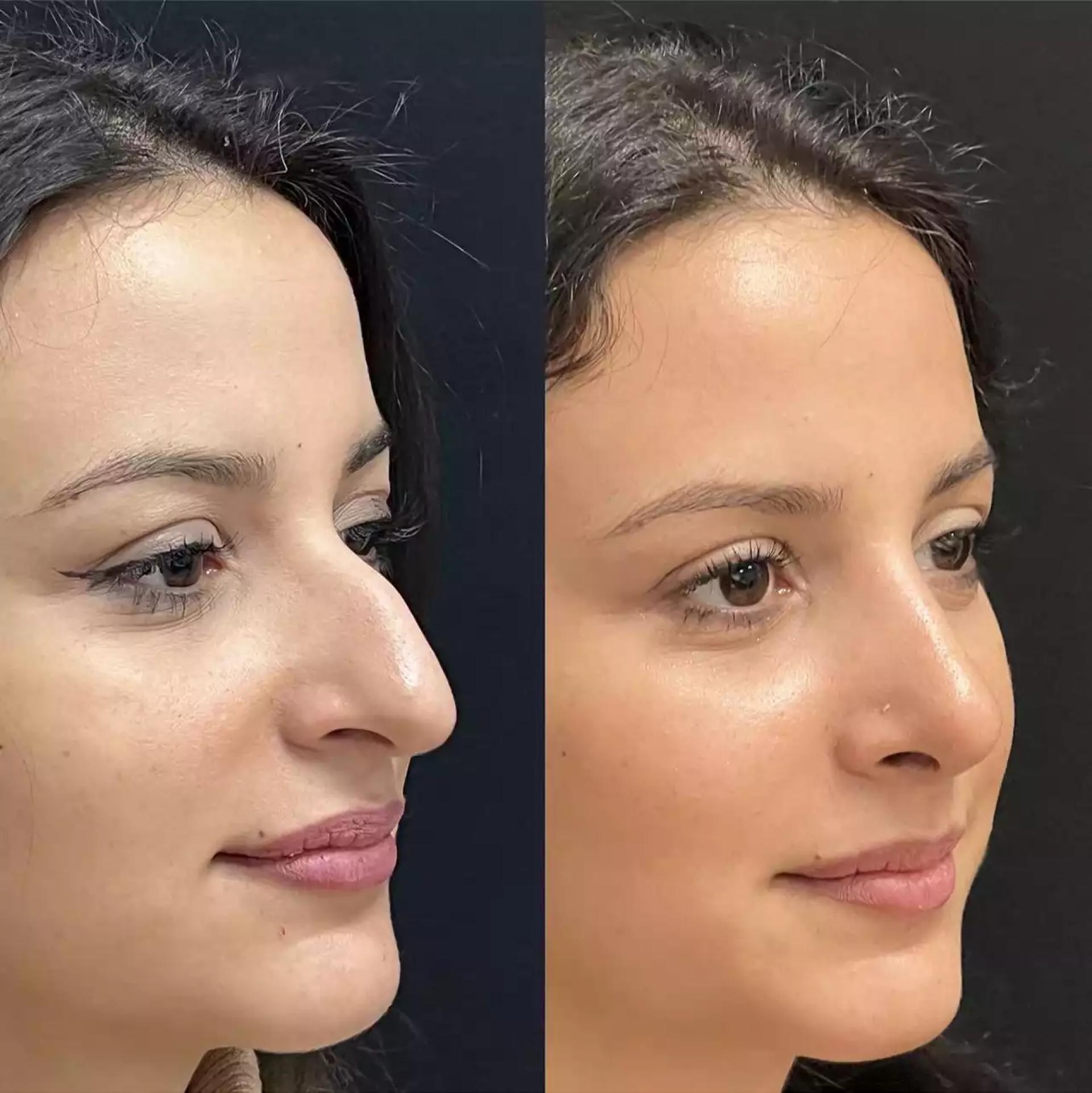 Is Nose Deviated Septum Surgery in Dubai Right for You?