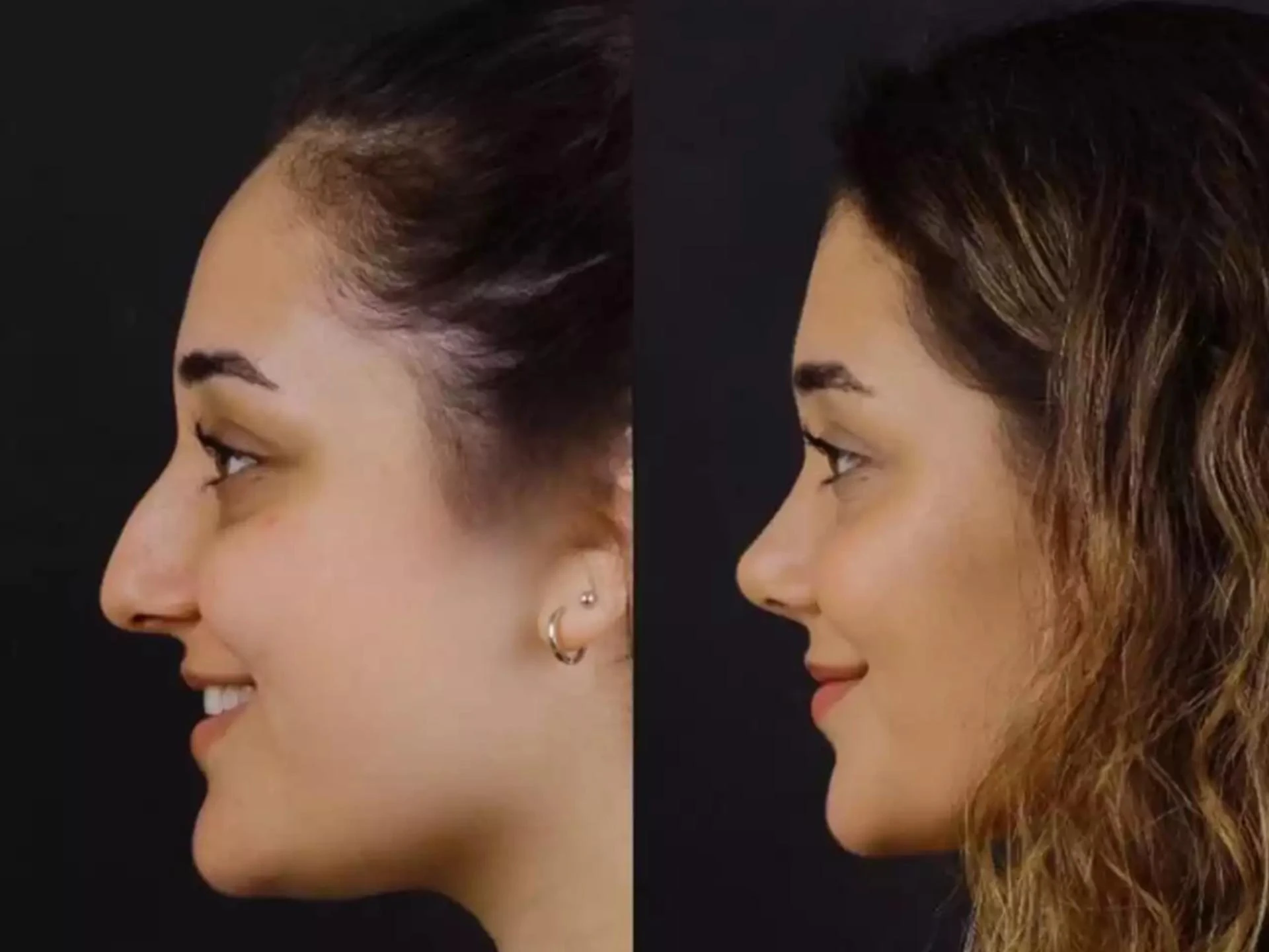 Relieve Nasal Discomfort with Septoplasty in Dubai