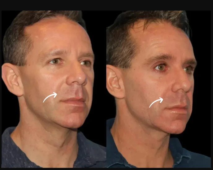 Can Sculptra Fillers Treat Smile Lines? Dubai’s Best Plastic Surgeons Weigh In