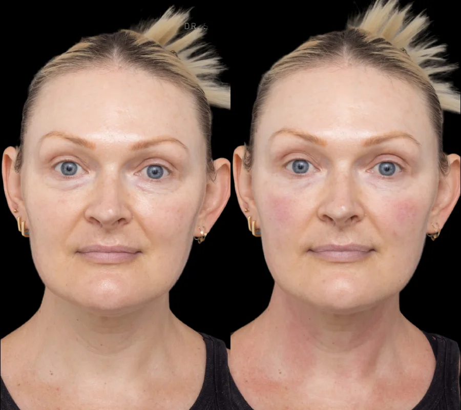 How the Best Doctors in Dubai Use Under Eye Fillers to Smooth Fine Lines