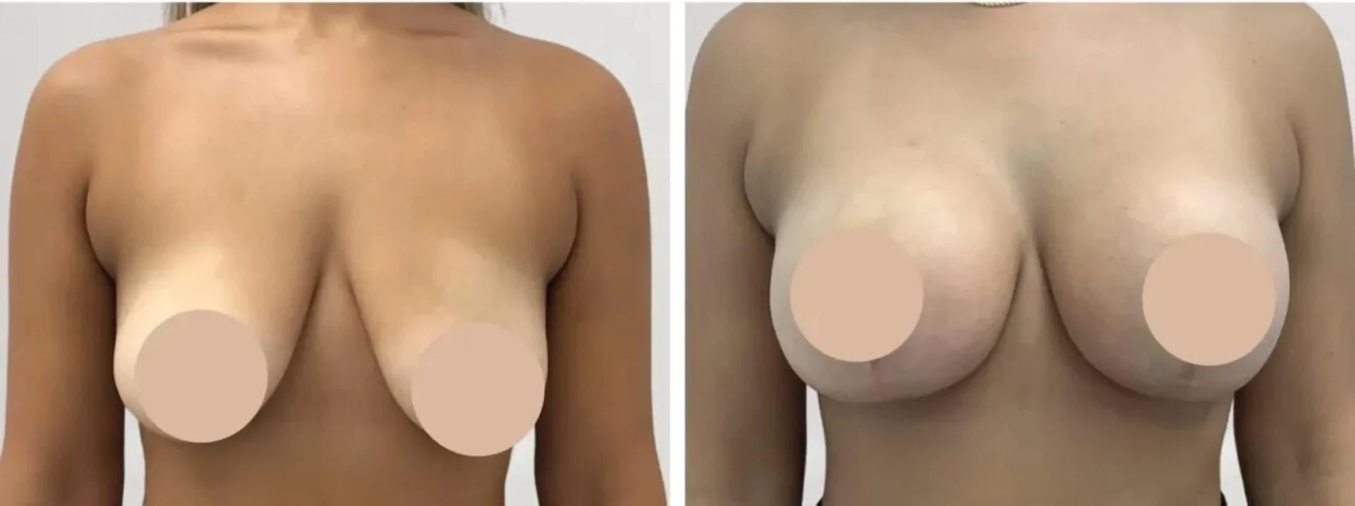 The Science Behind Choosing the Best Breast Reduction Surgeons in dubai
