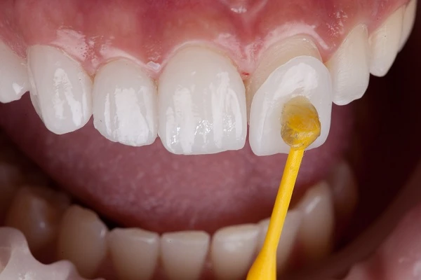 Transform Your Smile with Veneers in San Antonio, TX