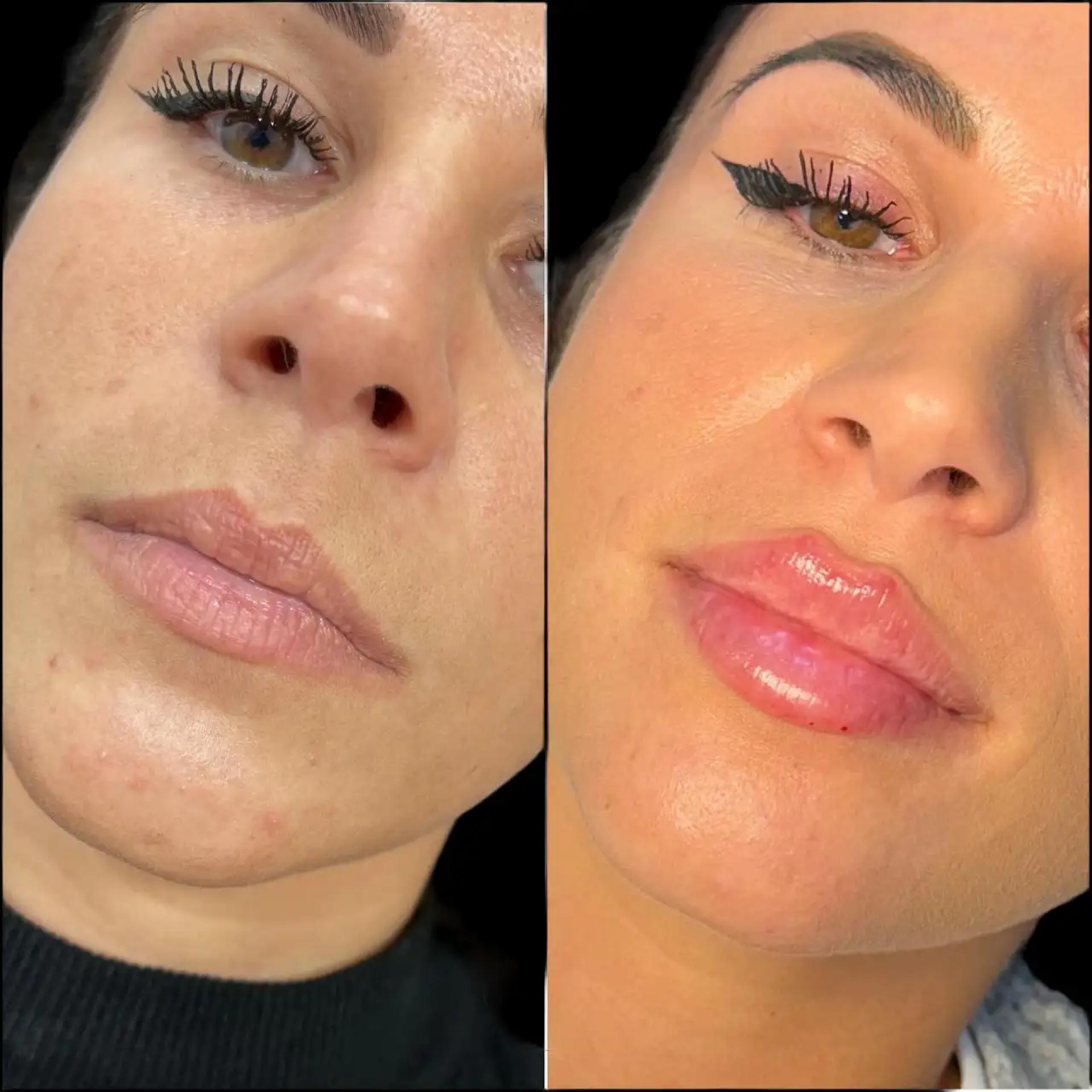 What Makes Fillers Treatment in Dubai So Popular