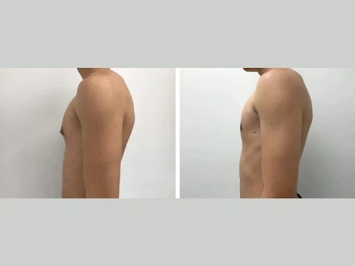 Emotional Benefits of Gynecomastia Surgery for Men in Dubai