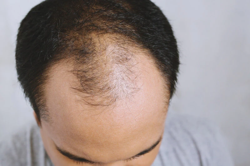 What Are the Best Hair Replacement Options?