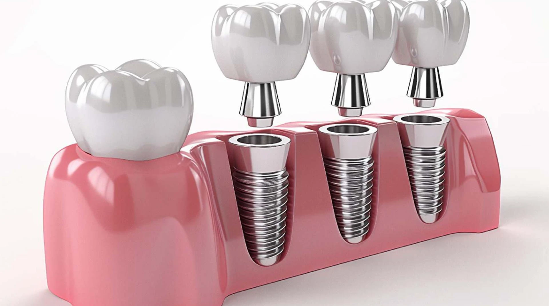 Painless Root Canal Treatment: A Modern Dental Marvel