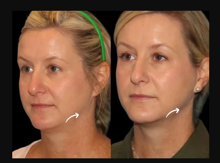 Patient-Centered Design: Clinic Aesthetics at the Best Plastic Surgeon in Dubai for Sculptra Fillers