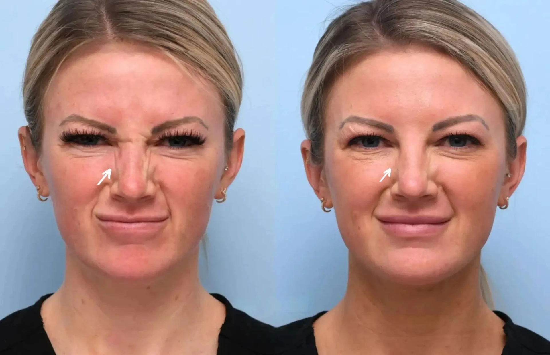 The Ultimate Guide to Botox: Best Plastic Surgeons in Dubai You Can Trust