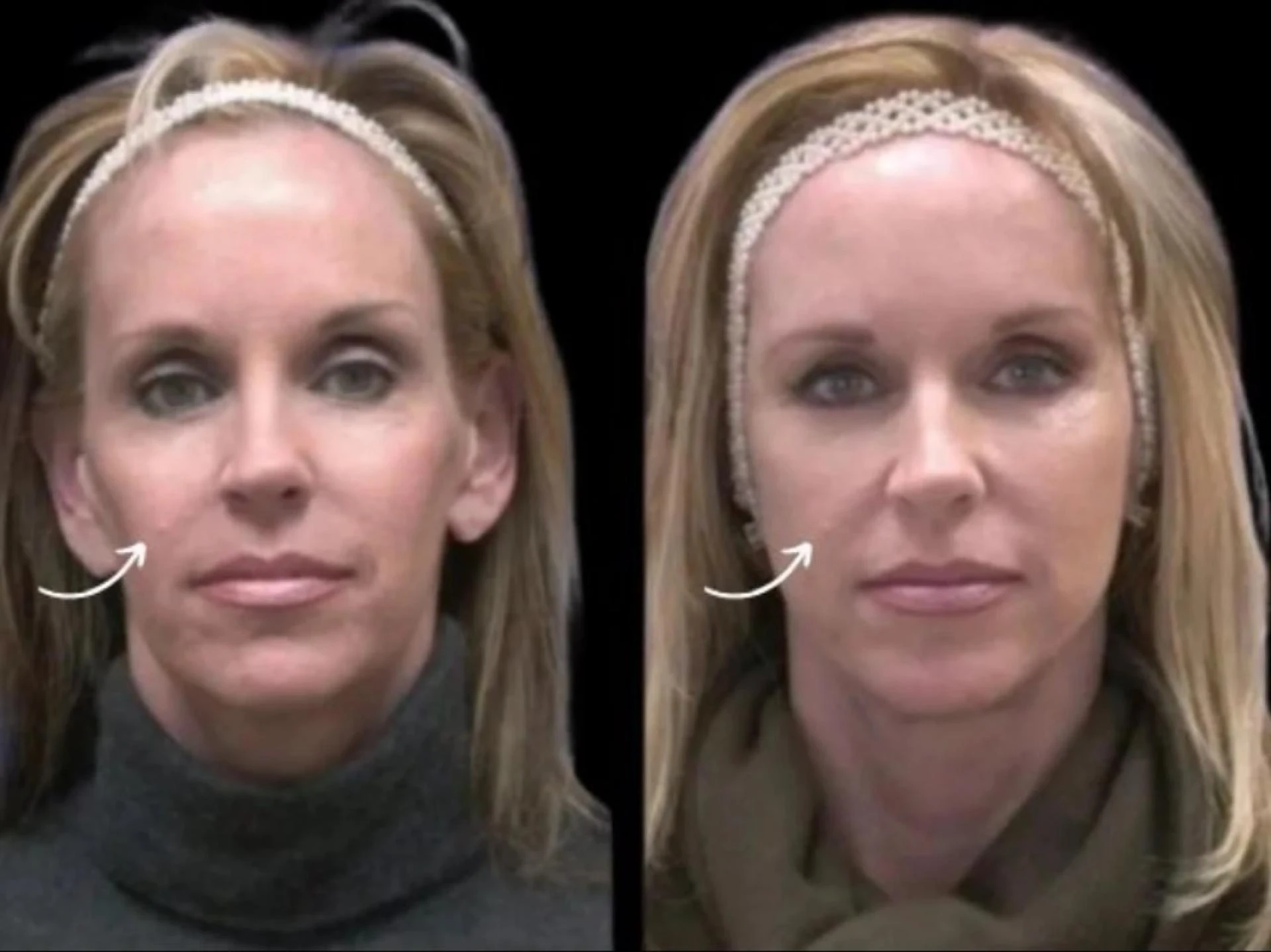 Intake Screening Criteria Used by Best Doctors in Dubai for Sculptra Fillers