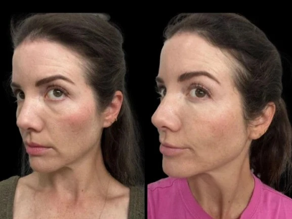 Best Aesthetic Doctors in Dubai for Under-Eye Fillers for Dark Circles Treatment