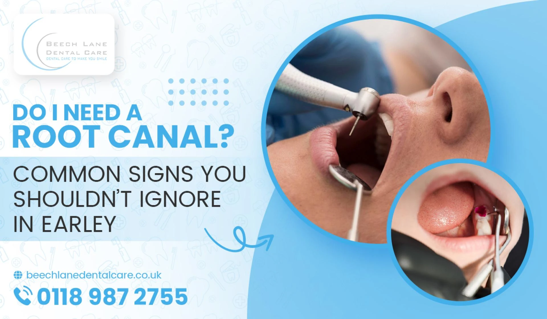 Do I Need a Root Canal? Common Signs You Shouldn’t Ignore in Earley