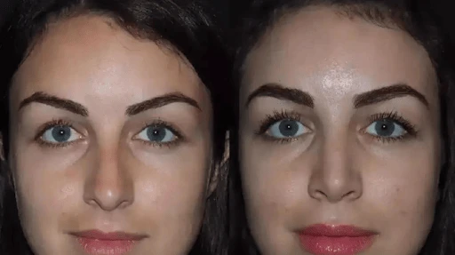 How Rhinoplasty in Dubai Is Changing Lives One Nose at a Time